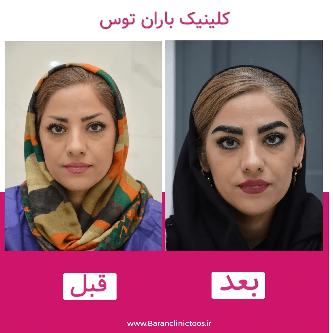 قبل و بعد کاشت ابرو